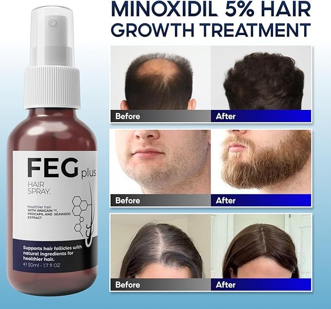 FEG plus hair growth treatment spray bottle with 'Minoxidil 5% Hair Growth Treatment' text and 'Before'/'After' images of hair growth.