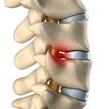 Herniated Discs